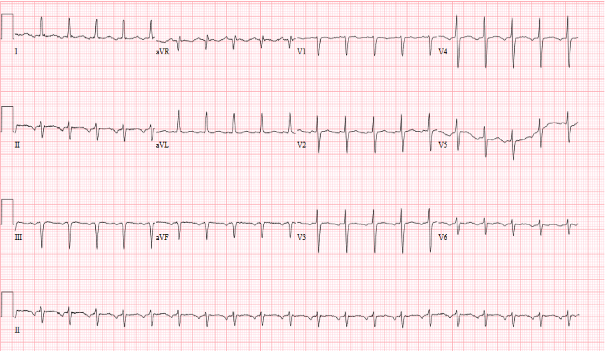 ecg5 postop.png